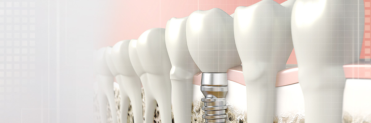 Plano Implant Dentist