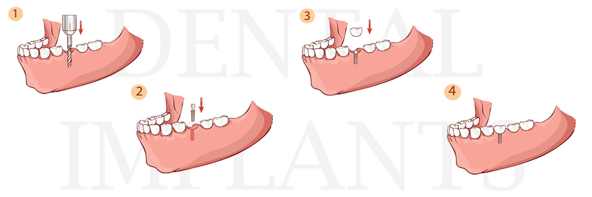 Plano The Difference Between Dental Implants and Mini Dental Implants