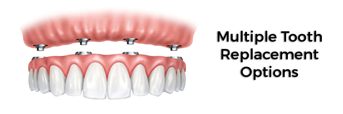 Plano Multiple Teeth Replacement Options