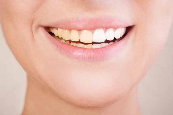 At Home Teeth Whitening Procedures