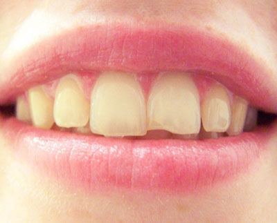 Cosmetic Tooth Bonding Plano TX