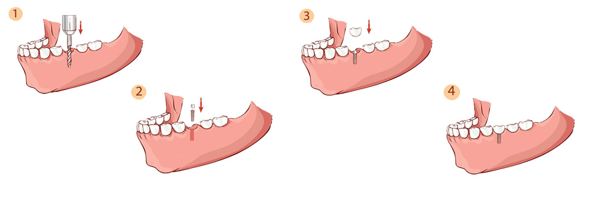 Plano The Dental Implant Procedure