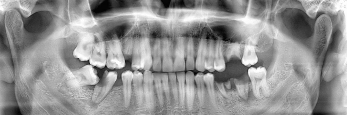 Plano Options for Replacing Missing Teeth